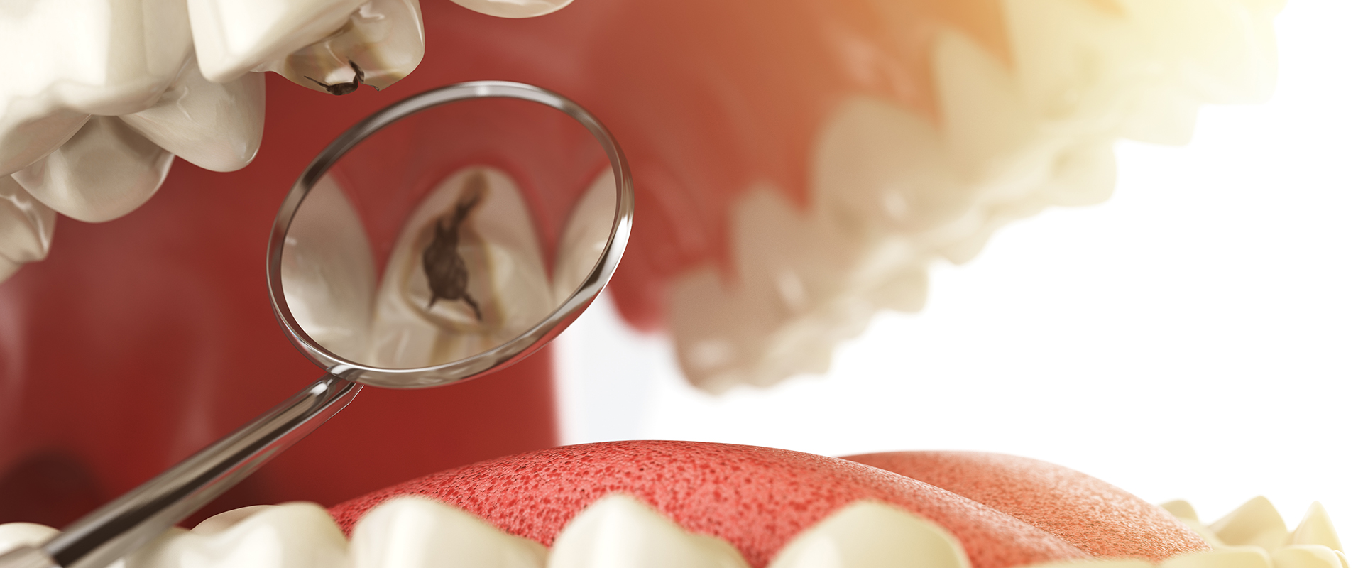 Dental-Fillings 